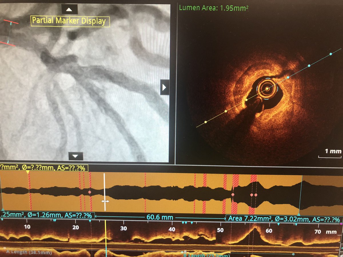 DrAmirKaki's tweet image. 85 yo active farmer with severe three vessel calcific disease and non dilateable lesions successfully treated with Impella supported OCT guided orbital atherectomy.  #completerevasc