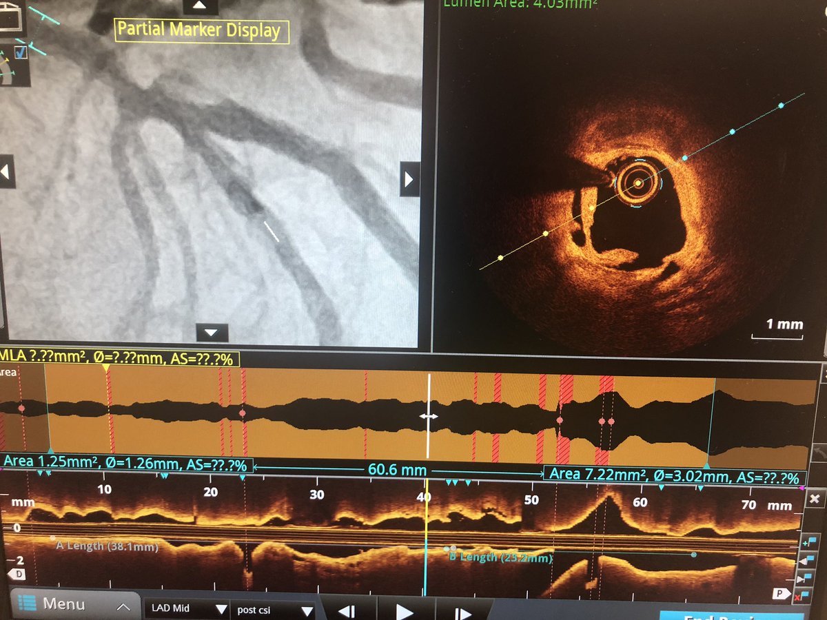 DrAmirKaki's tweet image. 85 yo active farmer with severe three vessel calcific disease and non dilateable lesions successfully treated with Impella supported OCT guided orbital atherectomy.  #completerevasc