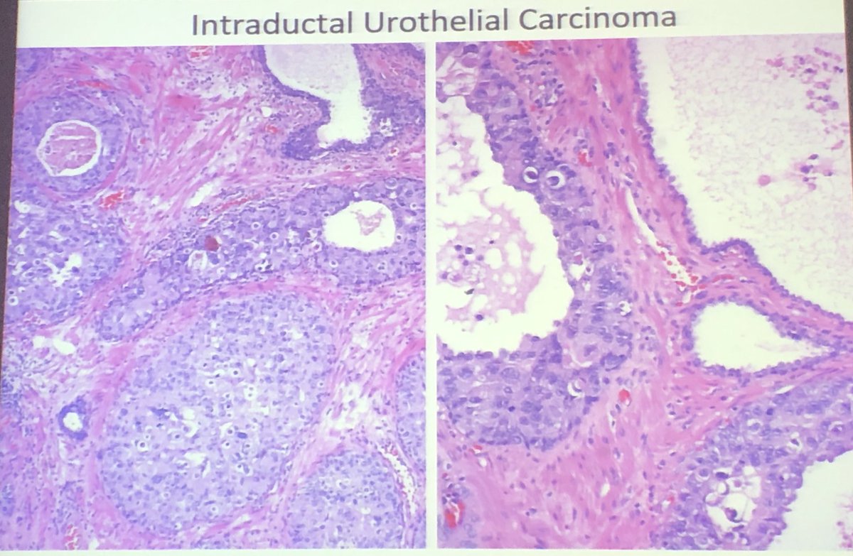DaoudRahal's tweet photo. #gupath #pathologist magic Magigalluzzi @DrCristinaMagi prostate Intraductal carcinoma DD https://t.co/XPRusVSVLq