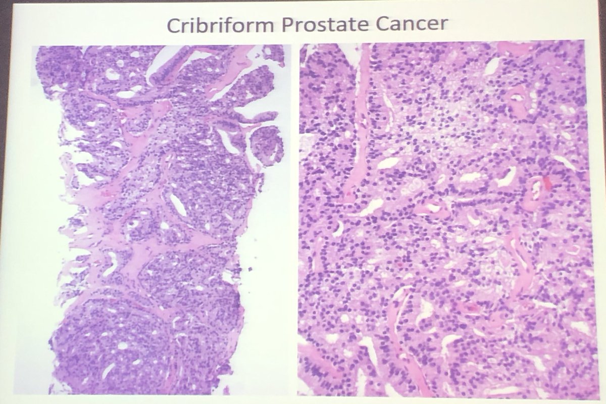 DaoudRahal's tweet photo. #gupath #pathologist magic Magigalluzzi @DrCristinaMagi prostate Intraductal carcinoma DD https://t.co/XPRusVSVLq