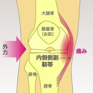 膝の痛みについて 内側側副靭帯損傷 東船橋で丁寧と評判 ミライエ鍼灸整骨院