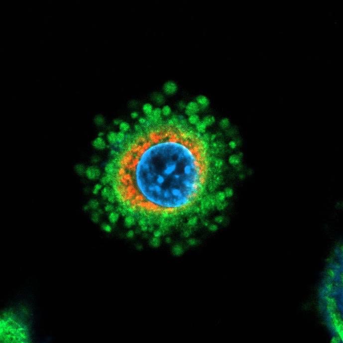 Essa foto dá orgulho de ser brasileiro. É uma célula cancerosa sendo destruída pelo vírus da zika ( em vermelho ao redor do núcleo em azul). Isso nos deu a ideia de transformar o vírus da zika em nosso aliado para destruir tumores cerebrais principalmente os infantis