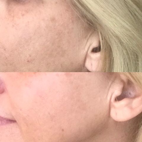 musely melasma reviews