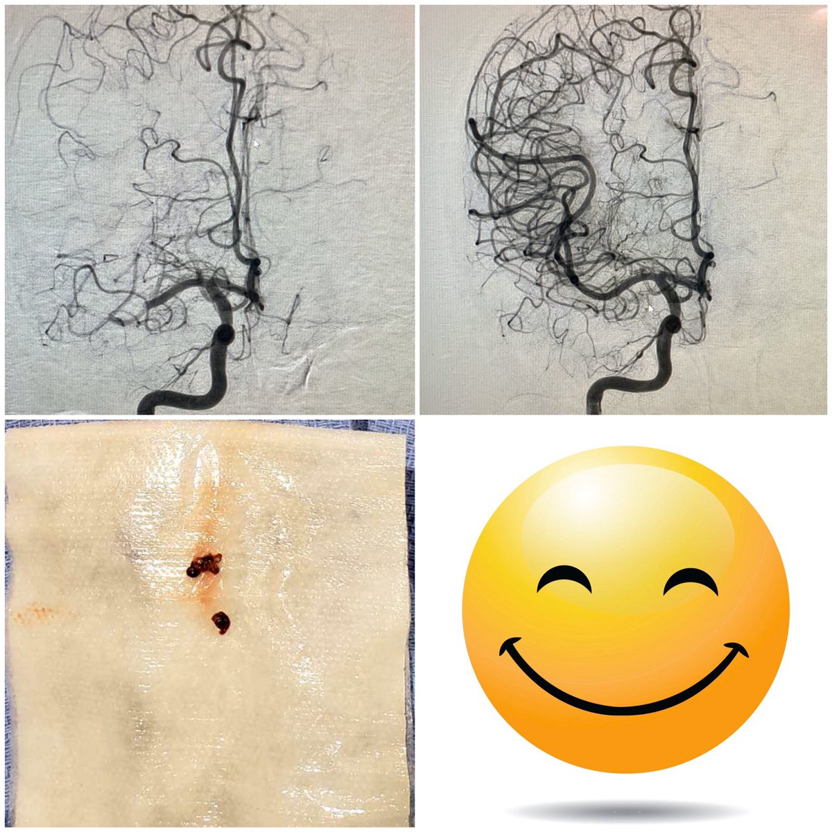 EinsteinIR's tweet photo. Aphasia & L Facial droop ➡️ R M1 ❌ ➡️ Door to 💉 19mins ➡️ Puncture to TICI 3➡️ 8mins ➡️ NIHSS 0 #OnTable
Pts first words ”Thank you Doc” with a huge #SMILE on the face #PRICELESS.
Fabulous work by @EinsteinIR and anesthesia team.
Bravo Dr. Paul Brady and @iRadRock https://t.co/iBFUDiIos8