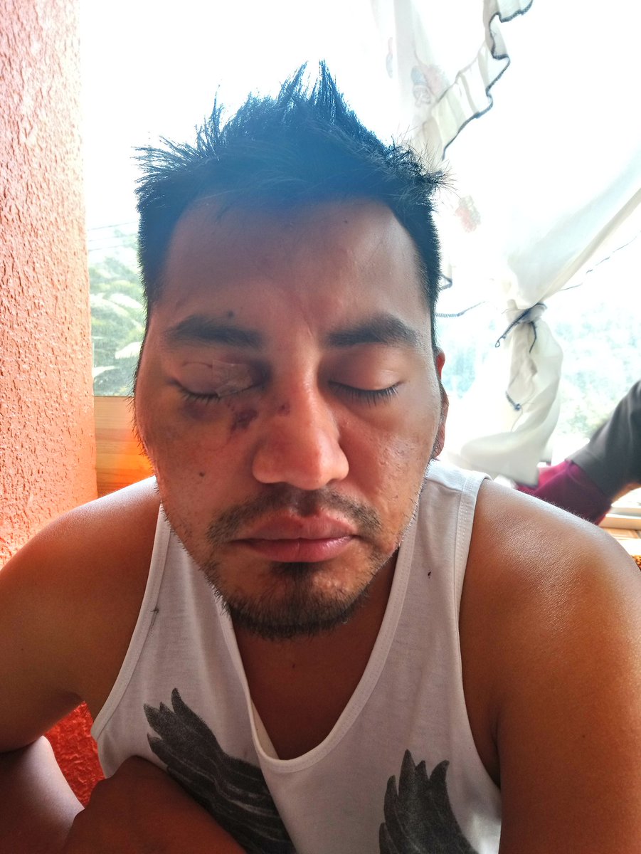 TipantunaAndrea's tweet photo. #CONCLUDIA9EC
Mi hermano perdió su ojo derecho en manifestación del jueves 3 de octubre y según la ministra de gobierno, no es nada.
La prensa no lo pasa, queremos Justicia
La situación es crítica en Ecuador, pedimos ayuda https://t.co/zhnRAgPy1m