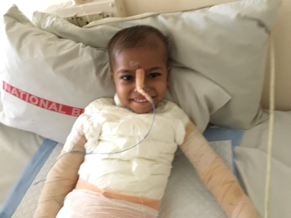 #OpRestore 2/2
The same child after surgery.  She was operated by some of the top plastic and trauma surgeons at Camp22 of #OpRestore organized by #RotaryDeonar and RCB North
We will see you again next week dear Bhagyashree for dressing change