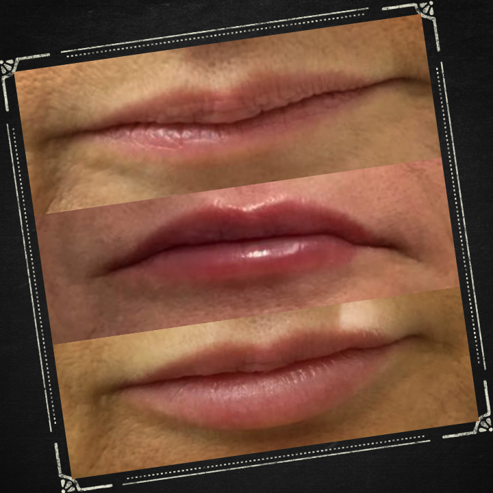 The healing process of lip fillers is important to consider.  Results can only be seen after 2 weeks.  Thin lips are ageing and subtle lip fillers can look great on women over 40.  This is  where Lorena has vast experience. #lips #lipfillers #beautyover40 #naturallipfillers