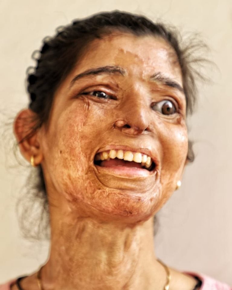 ' You burned my face but you fail to burn my smile'
-Ritu SAA

#Rebuildsheroes
To Support : milaap.org/fundraisers/re… #smile #burnedface #makelove