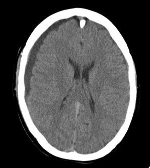 Prof Manjit Matharu (@manjit_matharu) on Twitter photo Dr Jane Anderson presenting cases at #HeadacheAcademy. Worsening of headache in IIH with shunt – consider overshunting in the differential. <a href="/UK_headache/">BASH</a> <a href="/NatMigraineCtr/">National Migraine Centre</a> <a href="/weatherallmw/">Mark Weatherall</a> <a href="/ABNTrainees/">Neurology Trainees</a> <a href="/GSTT_Headache/">Headache Service - GSTT</a> <a href="/DrMollan/">Dr Susan Mollan</a> <a href="/TN_UK/">Trigeminal Neuralgia Association UK</a> <a href="/IIHUK/">IIH UK</a> <a href="/neurokam/">Salwa</a> <a href="/csfleakinfo/">CSF Leak Association</a> Dr Jane Anderson presenting cases at #HeadacheAcademy. Worsening of headache in IIH with shunt – consider overshunting in the differential. <a href="/UK_headache/">BASH</a> <a href="/NatMigraineCtr/">National Migraine Centre</a> <a href="/weatherallmw/">Mark Weatherall</a> <a href="/ABNTrainees/">Neurology Trainees</a> <a href="/GSTT_Headache/">Headache Service - GSTT</a> <a href="/DrMollan/">Dr Susan Mollan</a> <a href="/TN_UK/">Trigeminal Neuralgia Association UK</a> <a href="/IIHUK/">IIH UK</a> <a href="/neurokam/">Salwa</a> <a href="/csfleakinfo/">CSF Leak Association</a>