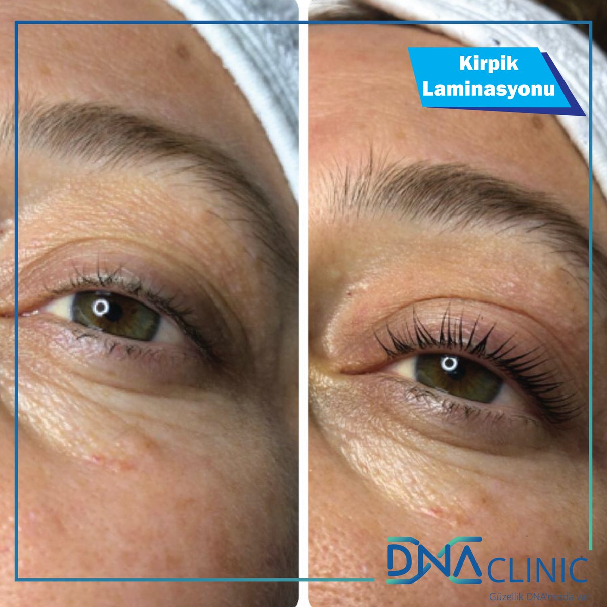 Kirpik laminasyonu ile kendi kirpikleriniz daha da güçlensin 🥰 #kirpiklaminasyonu #kirpikkeratinbakimi #kirpikkeratinbakımı #lashlifting #lashextensions #istanbul #dnaclinic #nişantaşı #nisantasi #izmir #ankara #güzellikDNAmızdavar
Nişantaşı
📱0532 460 117 9