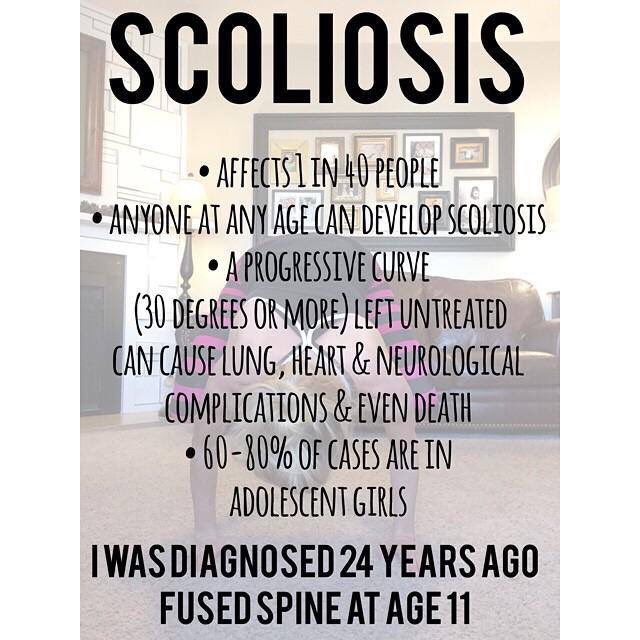 nursebricker's tweet photo. Love my brave scoliosis warrior! #bentbutnotbroken https://t.co/ftbA0Z627b