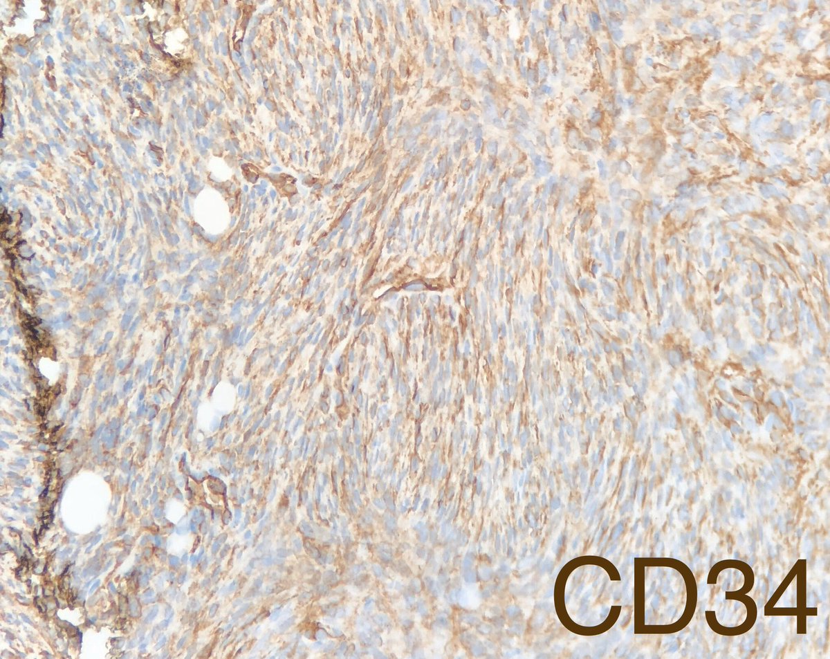 Got this <a href="/StanfordPath/">Stanford Pathology</a> Saturday on my dermpath rotation!
📝65 YO man with a cheek lesion
🔬 dermal based proliferation of hyperchromatic spindle cells in a storiform arrangement, invading deep subcutaneous fat
🦠CD34+, neg for F13A, keratin, S100, Caldesmon
#stanfordpathsaturday