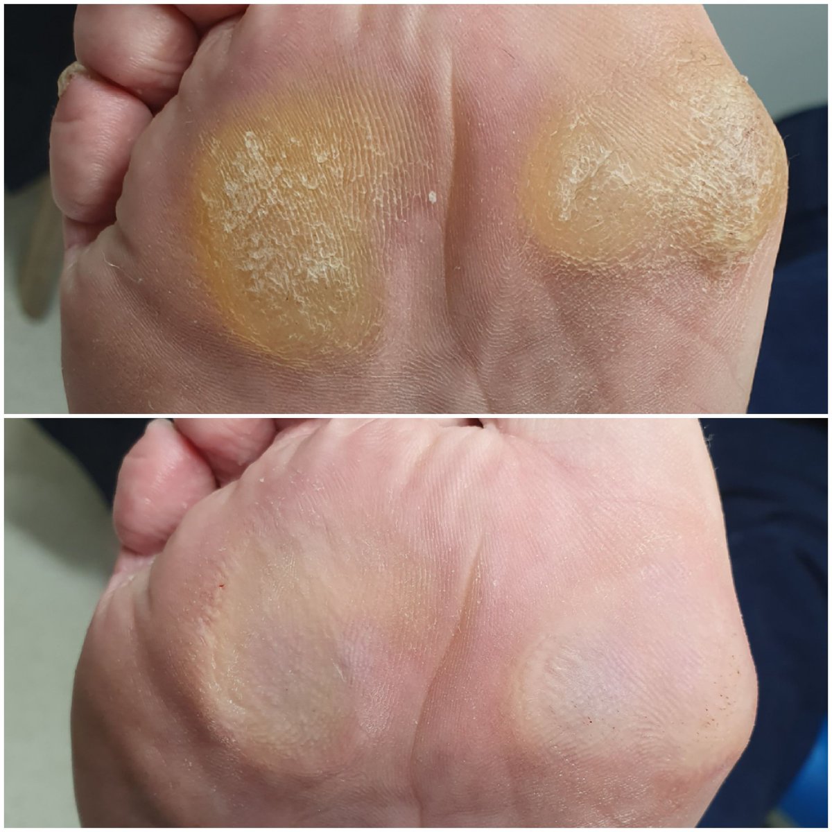 Painful #callous can cause you #pain with every step you take. We are able to remove the callous to give you immediate relief. <a href="/ashfordflowers1/">Sonia Bona</a> <a href="/JewellersAnupam/">Anupam Jewellers</a> <a href="/Xav_Anderson/">Xav Anderson - Clockwork City</a> <a href="/GoodbarnesHire/">Goodbarnes Hire</a> <a href="/ellawoodsoaps/">Ella Wood - Perfectly Natural</a> <a href="/TraceyC36680678/">Tracey Carter</a> @HitzoneA <a href="/ashfordwide/">Ashford Wide</a> <a href="/PartyPeopleTW15/">Party People</a> <a href="/haleybridgeUK/">Haley Bridge - Technology Recruitment</a>