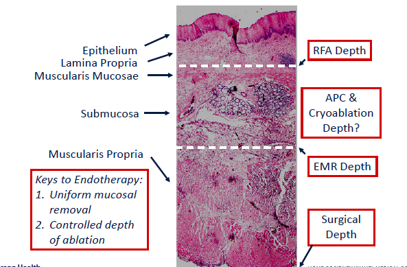 FITWITMD's tweet photo. Endoscopic Eradication Techniques (EET) & Mucosal Resection (EMR) can be utilized to strategically remove most lesions. More practitioner experience results in less number of sessions per patient required. High yield summary by Christina Tofani, MD #PAGASTRO2019 #PSGFIT #Barretts https://t.co/m1pHtdIFxk