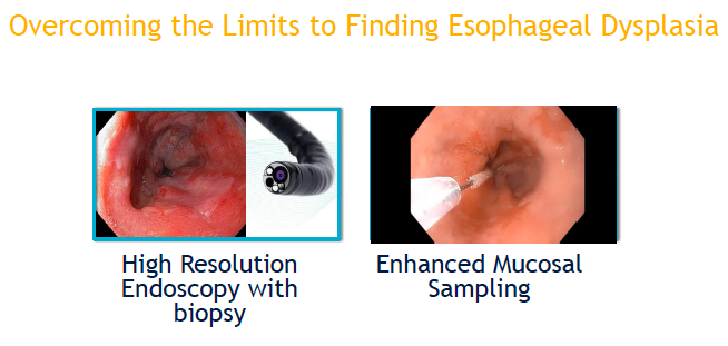 FITWITMD's tweet photo. In Barrett's, Endoscopists should be utilizing high def scopes w/NBI and also perform aggressive and thorough endoscopic biopsy to better visualize, sample and characterize Barrett's like mucosa. - Christina Tofani, MD #PAGASTRO2019 #PSGFIT #Barretts https://t.co/zvo9L8qv1A