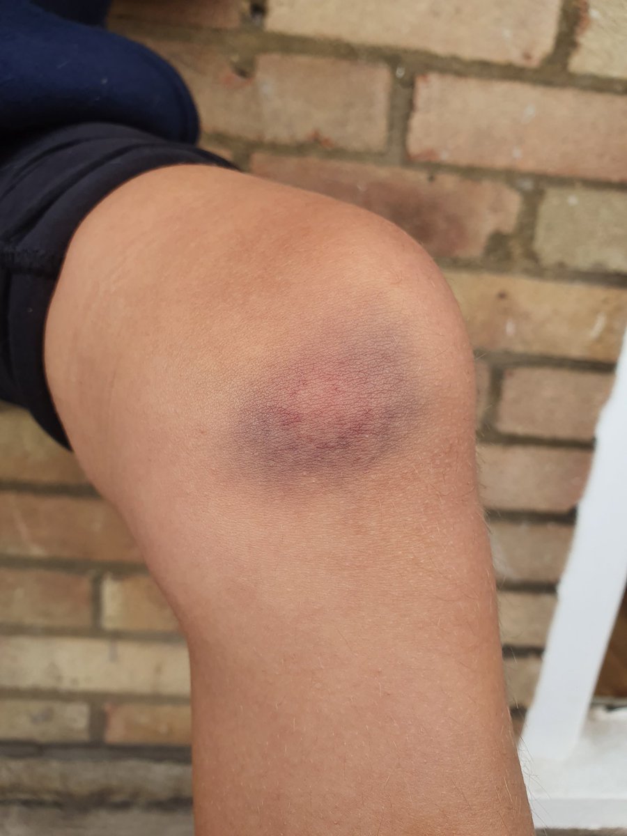 Mykingisrich's tweet photo. @LEGOLANDWindsor my 7yr old daughters injury due to slipping on the extremly wet floors in what was a very over crowded food court yesterday. No warning signs, floor was greasy like it had been cleaned with a dirty mop. Bruises like this for my child are dangerous. #sortitout https://t.co/7y1D3VSmnv