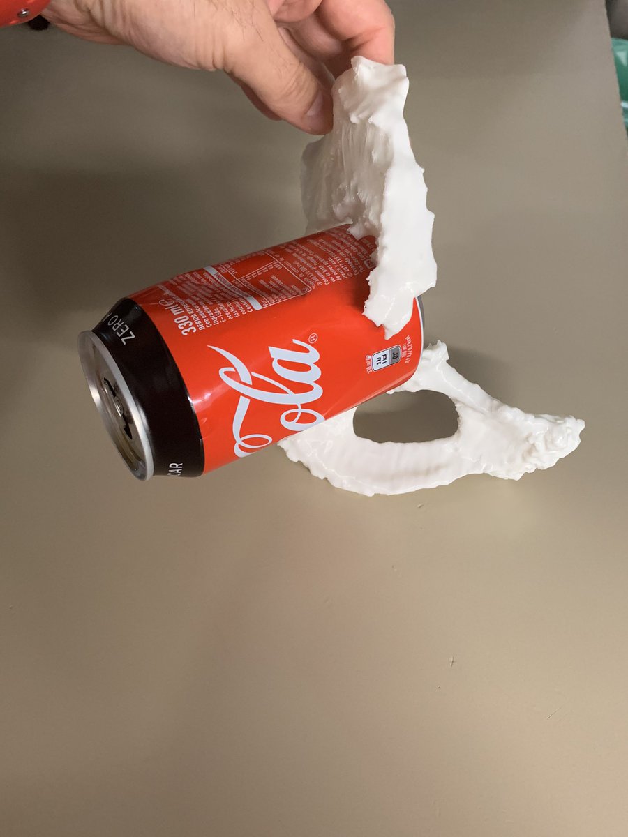 psanzruiz's tweet photo. @3d_maranon @rupermac @calvoharo_ja @diegotrap @luciagds @LauraFloresBM Amazing work! As usually! These images are from the second stage after 2 month! Easier and faster with the preop 3D planing! Best way to planning this big “bottle” acetabular defect!!! https://t.co/OcXfNtsVSx