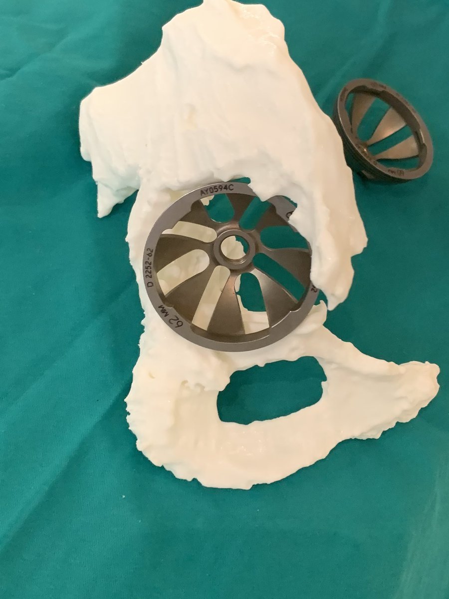 psanzruiz's tweet photo. @3d_maranon @rupermac @calvoharo_ja @diegotrap @luciagds @LauraFloresBM Amazing work! As usually! These images are from the second stage after 2 month! Easier and faster with the preop 3D planing! Best way to planning this big “bottle” acetabular defect!!! https://t.co/OcXfNtsVSx