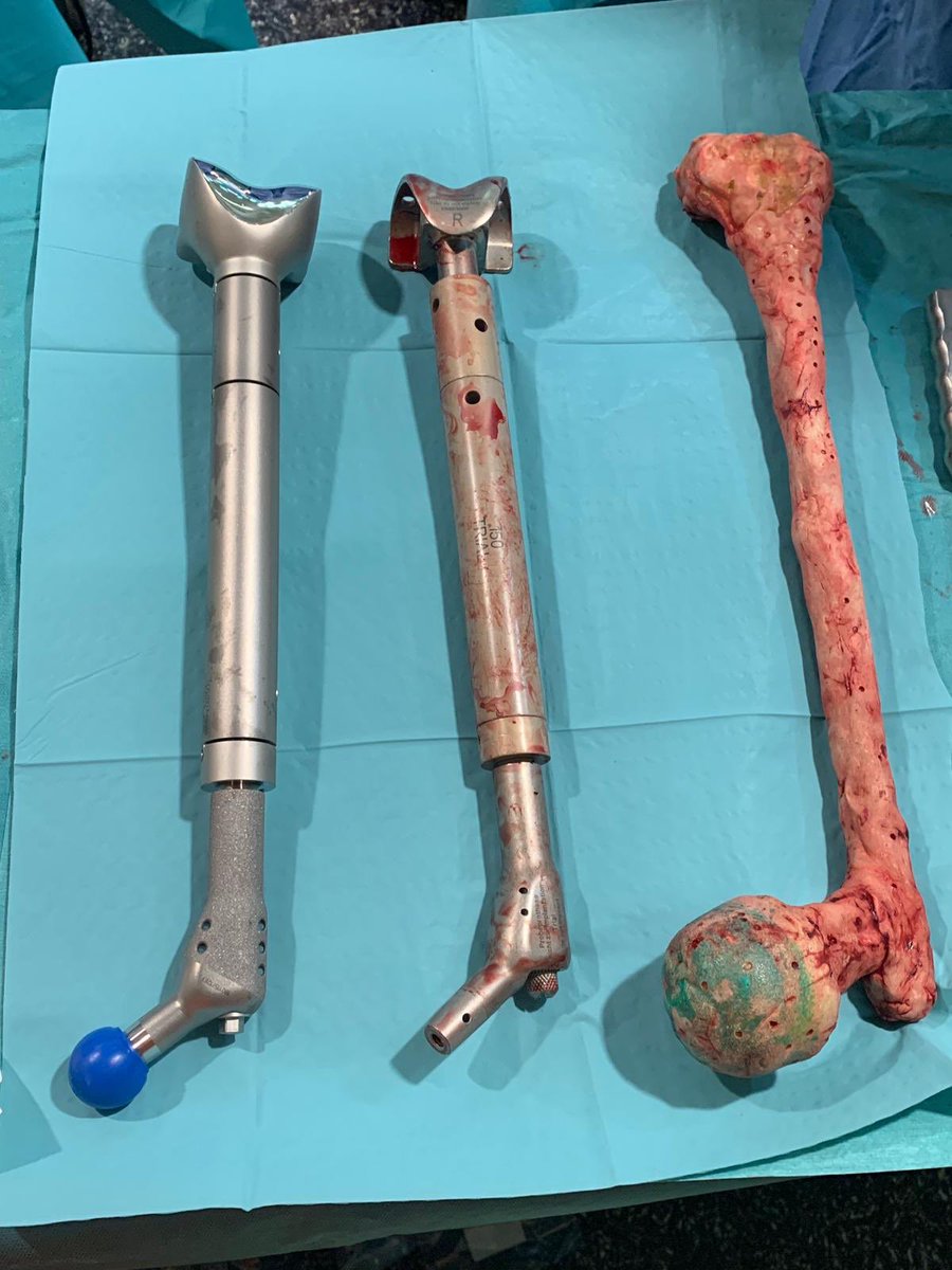 psanzruiz's tweet photo. @3d_maranon @rupermac @calvoharo_ja @diegotrap @luciagds @LauraFloresBM Amazing work! As usually! These images are from the second stage after 2 month! Easier and faster with the preop 3D planing! Best way to planning this big “bottle” acetabular defect!!! https://t.co/OcXfNtsVSx