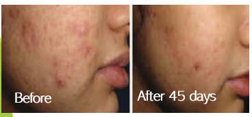 Wasabi 3 Step Acne System
wasabi4acne.com