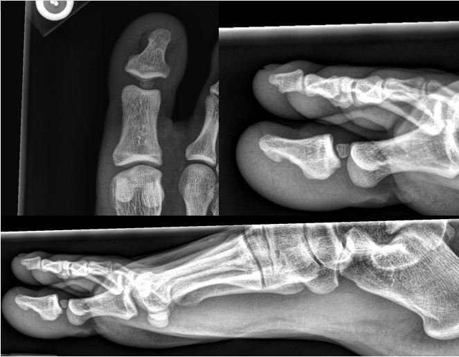 Entrapped #sesamoid in the big toe IP joint. Needs open reduction. Not so innocent after all...
#MSKradiology