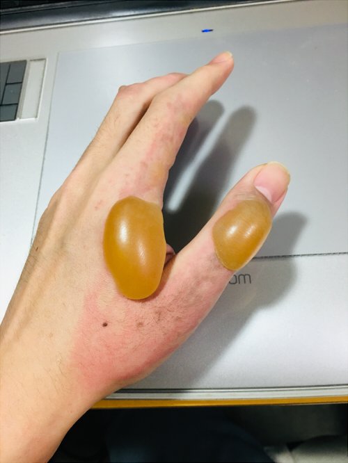 青色3号 利き手を火傷してしまった 油こぼして火傷した手 朝起きたら水ぶくれが5倍くらいに膨れ上がっていて驚愕 しばらくイラスト投稿は出来ないかも 病院行ってきます 画像閲覧注意 T Co Msaitvhmqi Twitter 青色3号 利き手を火傷してしまった 油こぼして火傷した手 朝起きたら水ぶくれが5倍くらいに膨れ上がっていて驚愕 しばらくイラスト投稿は出来ないかも 病院行ってきます 画像閲覧注意 T Co Msaitvhmqi Twitter