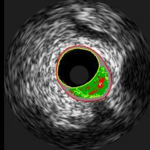Saint Luke's Mid America Heart Institute (@midamericaheart) on Twitter photo Since 2004, the CV imaging core lab at <a href="/MidAmericaHeart/">Saint Luke's Mid America Heart Institute</a> has provided accurate and independent image analysis for numerous clinical trials and registries, with a focus on echocardiography and coronary angiography. We are open for business!
saintlukeskc.org/icl Since 2004, the CV imaging core lab at <a href="/MidAmericaHeart/">Saint Luke's Mid America Heart Institute</a> has provided accurate and independent image analysis for numerous clinical trials and registries, with a focus on echocardiography and coronary angiography. We are open for business!
saintlukeskc.org/icl