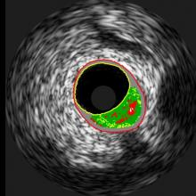 Since 2004, the CV imaging core lab at @MidAmericaHeart has provided accurate and independent image analysis for numerous clinical trials and registries, with a focus on echocardiography and coronary angiography. We are open for business! saintlukeskc.org/icl