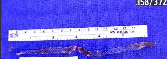 MaryRMcL1's tweet photo. #Mesh and no guarantees - "as far as possible" is not a catch-all phrase to excuse a #notafullremoval surgeon.  Safe #Fullremoval surgeons may leave mesh behind due to high risk . eg. on the bone,near major artery. Not a default excuse to leave behind 2/3 TVTO on regular basis. https://t.co/9bameg0yv1
