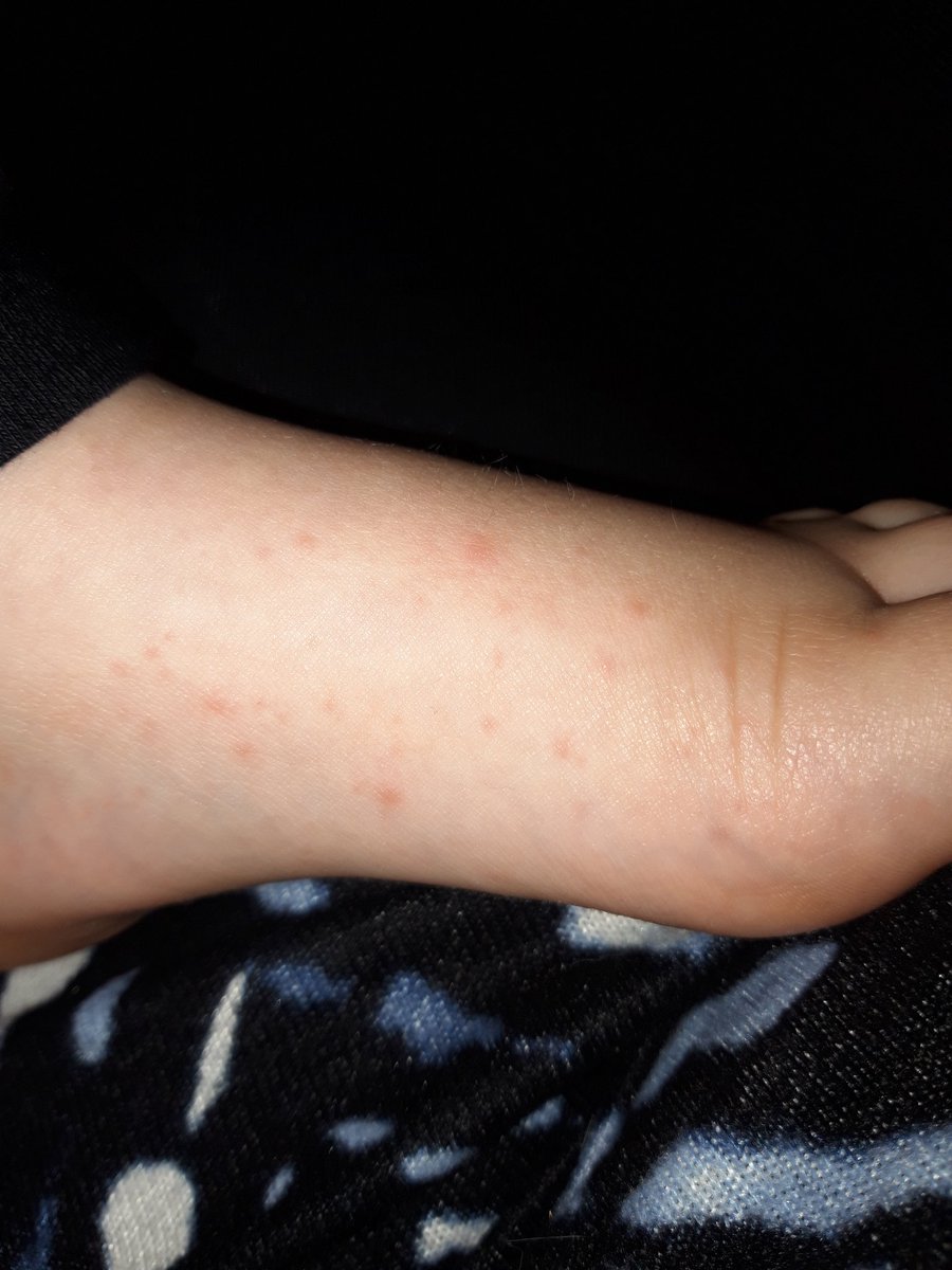 GuilliattHall's tweet photo. #hand #foot #mouth #poorlyfortheholidays
#stillsmiling https://t.co/zVJeShPr1h
