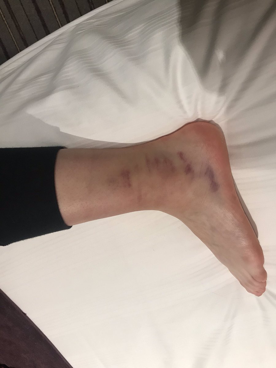 Karlmarriott5's tweet photo. @Amymarriott13 damaged ankle at army residential at school yesterday. Then decided that she had to play at Stockton 4* today. Hard Yorkshire lass. https://t.co/JJ4AOUMFBY