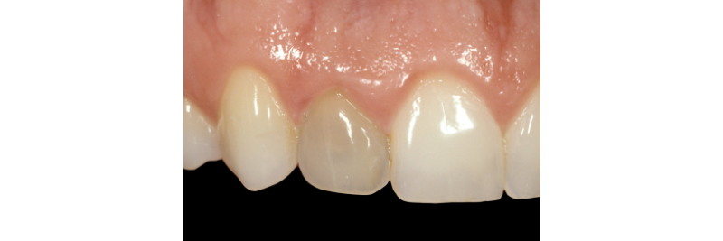 greggkinzerdds's tweet photo. Learn more about how internal bleaching to treat a dark tooth is now possible treatment option: https://t.co/ezRqdQqOG6 https://t.co/ndRr0UJN90