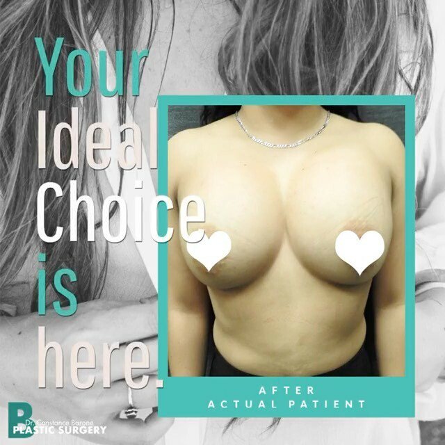 Start your own #after and know that you don’t have to sacrifice your health for beauty with the #IdealChoice for breast implants: the @idealimplant. Great results, a natural feel, and youthful shape with your safety and comfort in mind are yours when you… ift.tt/2MMV557