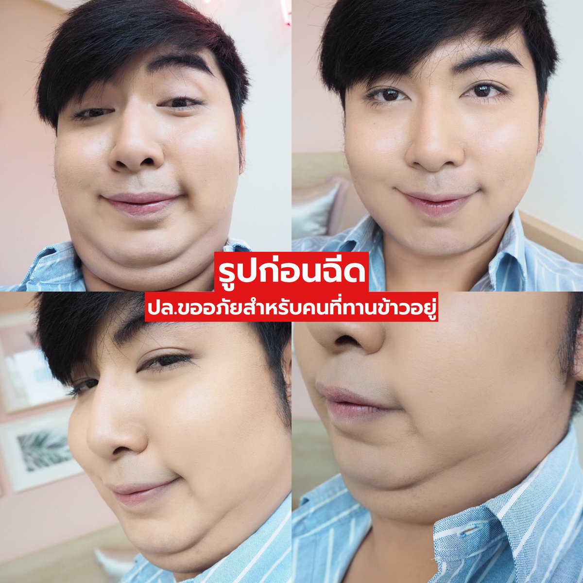 Khongmuntongmee's tweet photo. เอาเป็นว่า ชั้นมาพลีชีพให้ทุกคนได้รู้ของดีแล้วกัน...
สวัสดีค่ะ ชื่อขวัญ อายุ24ปี สูง185 น้ำหนัก130!!! ใช่ค่ะอ่านไม่ผิด หนัก130 จริงๆ แค่รู้มุมหน้าตัวเองถ่ายรูปเลยดูผอม เพราะไม่เห็นตัว55555 
ด้วยความอยากสวยขึ้น เห็นเพื่อนไปฉีด Fat, Botox แล้วหน้าสวยขึ้นอะ เลยตัดสินใจไปทำบ้าง https://t.co/lZInywOaua