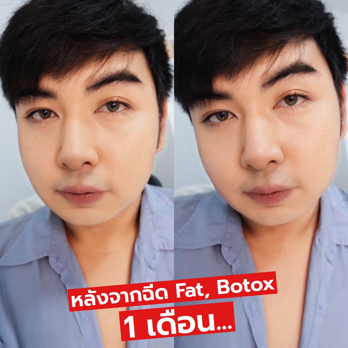 Khongmuntongmee's tweet photo. เอาเป็นว่า ชั้นมาพลีชีพให้ทุกคนได้รู้ของดีแล้วกัน...
สวัสดีค่ะ ชื่อขวัญ อายุ24ปี สูง185 น้ำหนัก130!!! ใช่ค่ะอ่านไม่ผิด หนัก130 จริงๆ แค่รู้มุมหน้าตัวเองถ่ายรูปเลยดูผอม เพราะไม่เห็นตัว55555 
ด้วยความอยากสวยขึ้น เห็นเพื่อนไปฉีด Fat, Botox แล้วหน้าสวยขึ้นอะ เลยตัดสินใจไปทำบ้าง https://t.co/lZInywOaua