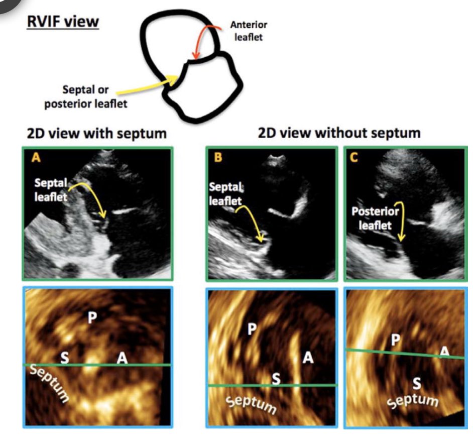 iamritu's tweet photo. @DrShemisa @scrivsy85 Posterior https://t.co/Qjzc6WXmjF @JournalASEcho 
RVIF leaflet nearest aortic valve is A leaflet &amp; if see septum then A-S leaflets PSAX most variable:A-P if central coaptation &amp;P-S if lvot or septum seen, A-S if not midline coaptation
RVF view if LVOT ➡️A-S,if CS ➡️P-S #echofirst https://t.co/zgk3Ot4Aw3