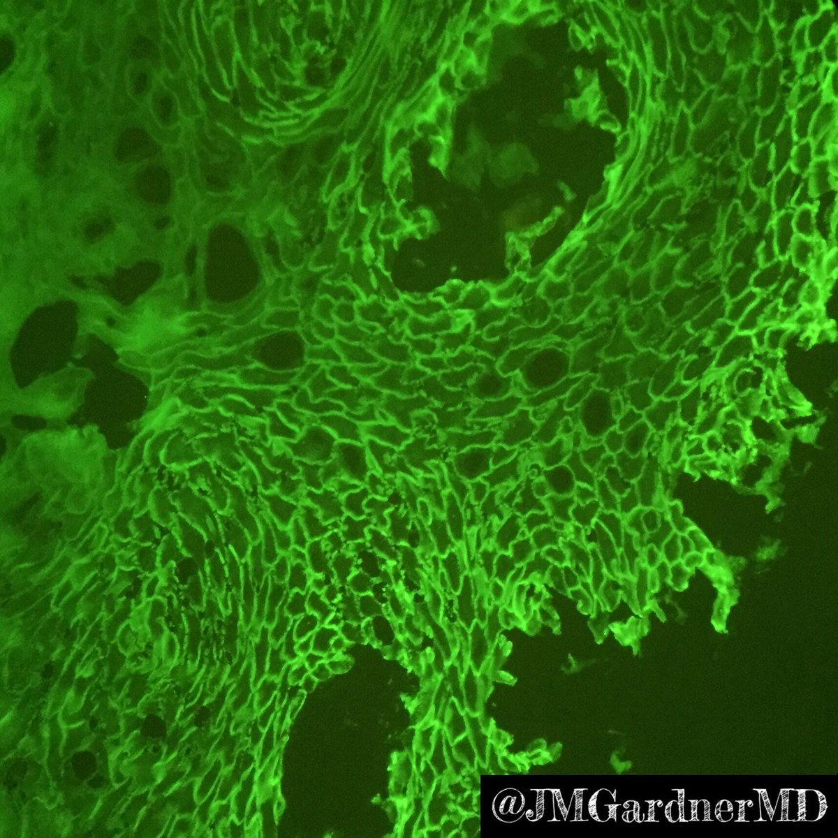 JMGardnerMD's tweet photo. Pemphigus vulgaris: Acantholytic suprabasilar blister. Fishnet IgG & C3 on DIF (autoantibodies target desmogleins 1&3). Learn my basic approach to blistering skin diseases in my #dermpath #pathsurvivalguide by @innovpathpress: https://t.co/J6j28tg5t2 #pathology #dermatology https://t.co/7a3d0Epjwx