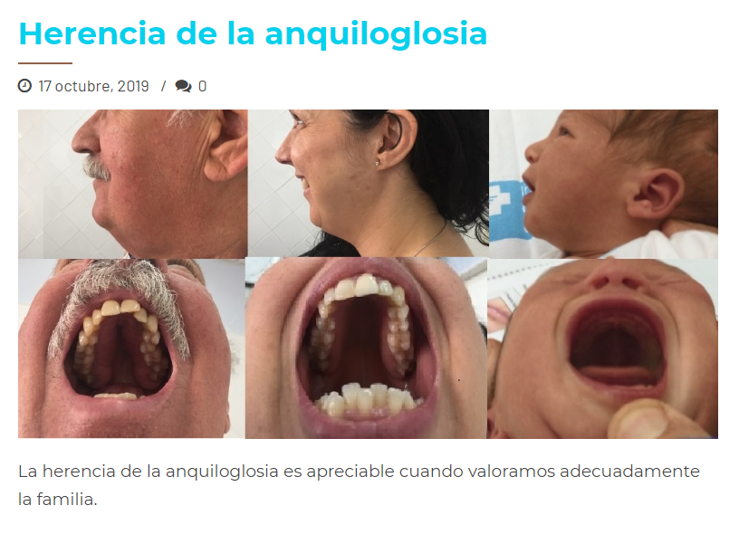LRuizGuzman's tweet photo. En la anquiloglosia o frenillo lingual corto la herencia familiar es importante. En UDIADEAN hemos investigado este aspecto. Quizás los adultos con esa dentadura han comido mal, como el bebé. Podeis ver el articulo: https://t.co/IAK3KogI8X  y https://t.co/TLuSKwxAE8. Compartir! https://t.co/SzQnCtaXdu
