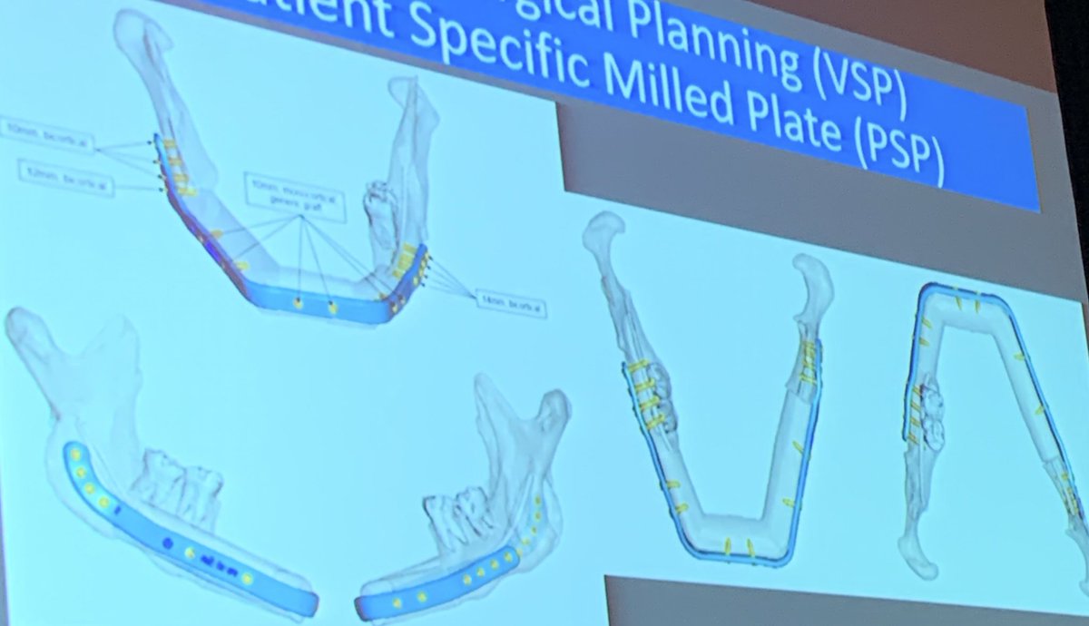 Dr. Okay’s comprehensive discussion on facilitating #oralreconstruction #oralrehabilitation with #virtualsurgicalplanning