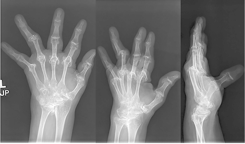 Team Approach: Role of Medical and Surgical Management in Rheumatoid Arthritis of the Hand and Wrist ow.ly/8x9050wUSxi