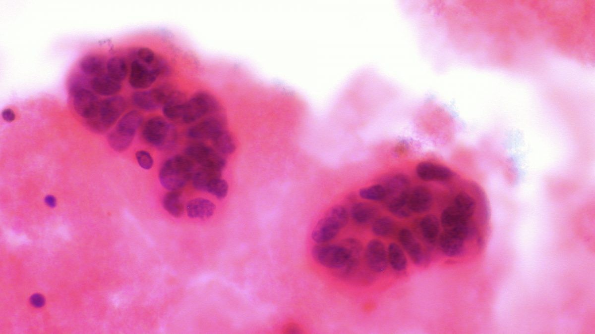 Oxidized cholesterol (concentrated in products containing eggs, processed meat, and parmesan cheese) has cancer-fueling estrogenic effects on human breast cancer. 
bit.ly/2OorAcc