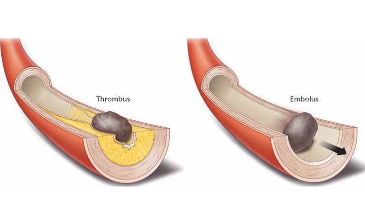 Тромб и бляшка разница. Тромбозы и эмболии артерий.