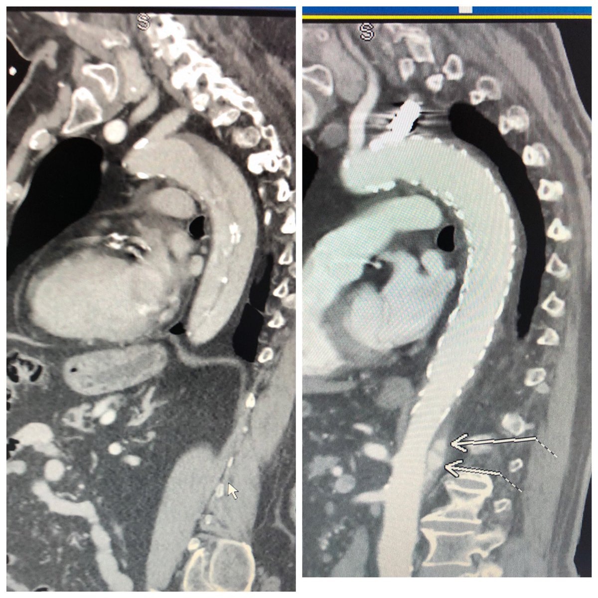 Paul O'Connor (@p_oconnor1) on Twitter photo One month follow-up s/p percutaneous TEVAR/ carotid subclavian bypass for aortic dissection. Nice false lumen remodeling 👍🏼 with minimal filling on f/u CT <a href="/JParkMD/">Joseph J. Park</a> <a href="/VascMD/">Rami Tadros</a> <a href="/PIH_IR/">PIH IR</a> One month follow-up s/p percutaneous TEVAR/ carotid subclavian bypass for aortic dissection. Nice false lumen remodeling 👍🏼 with minimal filling on f/u CT <a href="/JParkMD/">Joseph J. Park</a> <a href="/VascMD/">Rami Tadros</a> <a href="/PIH_IR/">PIH IR</a>