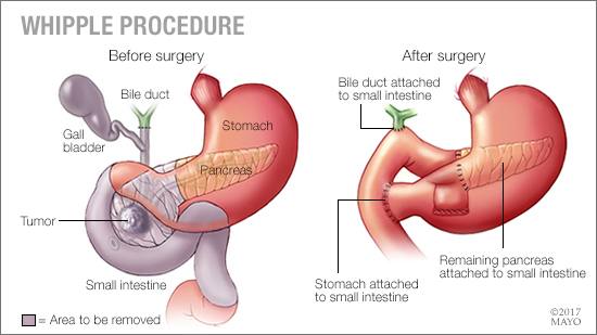 MayoClinic's tweet image. The #WhippleProcedure, a difficult and demanding operation posing serious risks, is often lifesaving for #PancreaticCancer confined to the head of the pancreas. Talk with others discussing risks and benefits on #MayoClinicConnect. mayocl.in/33T1e5w