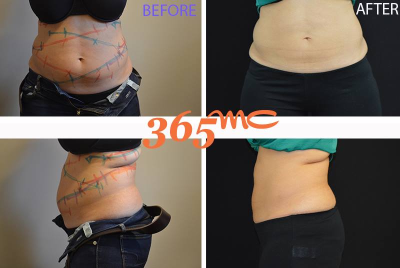 365mc Liposuction Hospital is the best for #Abdominal_liposuction Details: snip.ly/fjyfcs Fee consultation: E-mail: doctor@365mcglobal.com #liposuctiontoremovefacefat #abdominaltummytuck #abdominalliposuctionprice #BestKoreanPlasticSurgeryClinics #bodyliposuction #365mc