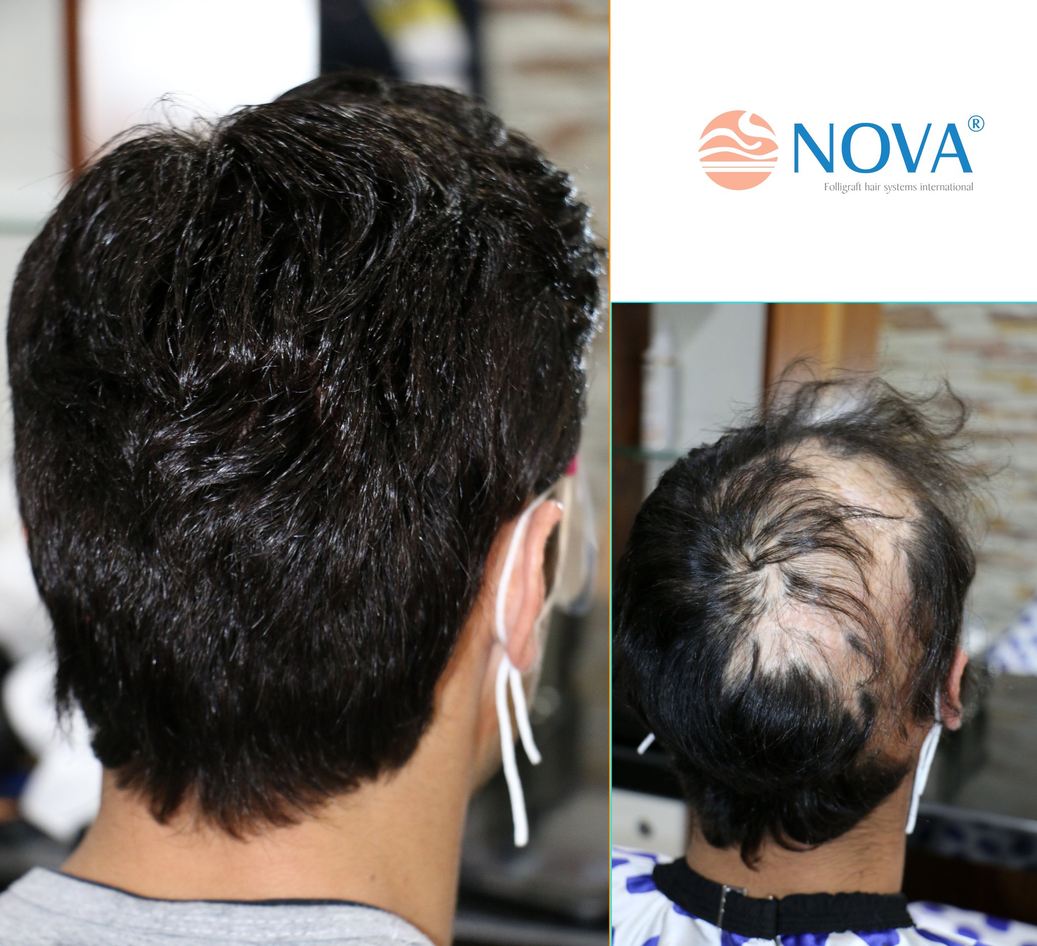 Nova Sac Sistemleri On Twitter Folligraft Ile Yanik Sonucu Olusan Sac Kayiplarina Cozum Sundugumuzu Biliyor Musunuz Bolgesel Sac Kayiplarinda 100 Dogal Cozumler Folligraft Novahair Sacekimi Protezsac Hairreplacement Hairloss