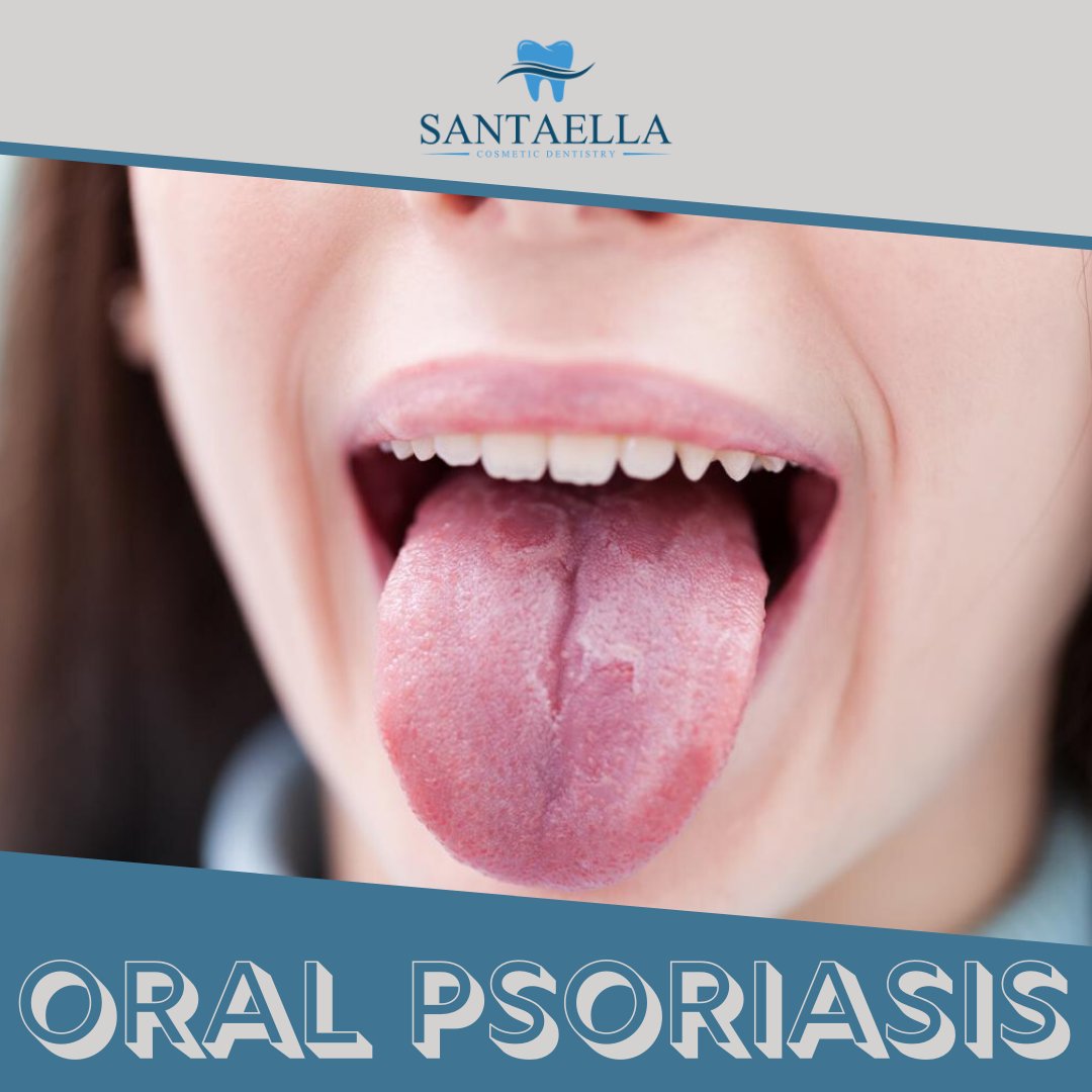 SantaellaPR's tweet photo. Psoriasis was commonly believed to affect only the obvious spots in a person’s body such as the elbows, knees, and scalp. 

🔎 https://t.co/VCkMmHCycl
📍 Guaynabo, Puerto Rico 
📞 Phone: (787) 620-2500 https://t.co/DISmY60Gct