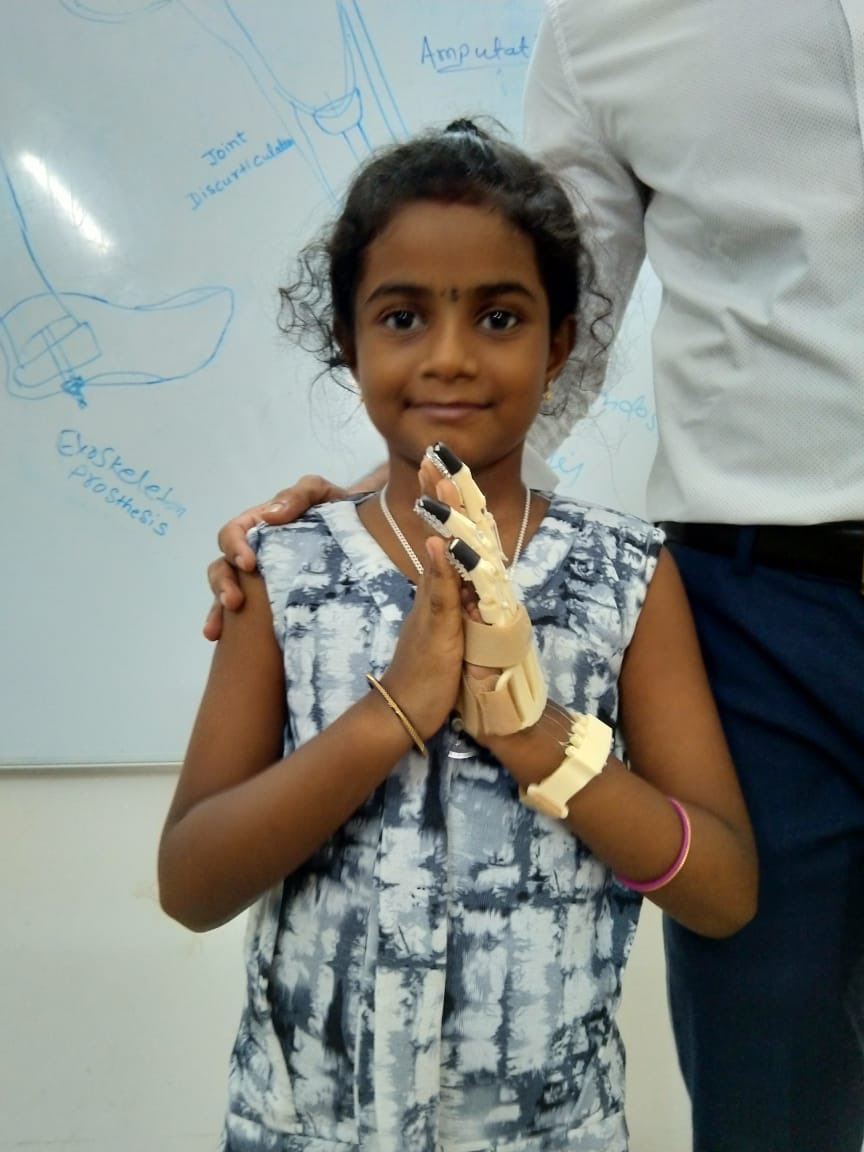 anilbhatortho's tweet photo. #3Dprosthesis our centre for #congenitalhand differences print these for children with special hands . The more we give,  the more we receive :A child’s smile 😊 #Teamwork #3DHastha @Aammaarrttyyaa @satyam0521 @SamheelMohammad @VMundluru @Orthofacts @Congenitalhand https://t.co/3Vjp2iF0o1