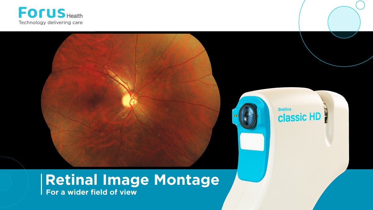 The #3nethra #classicHD #digitalfunduscamera is designed with a Retinal Image Montage tool that stitches together multiple fields of view captured by a clinician. This allows for a wider view of the retina, up to 75°, which is more when compared to a standard fundus camera at 45°