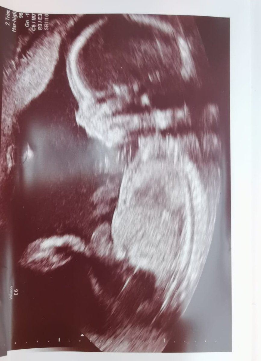 Unfruitful13's tweet photo. #20w1d I never thought we would ever get this far. Our beautiful embryo Eleven has made it to her 20 week anomaly scan and was wriggling around and measuring perfectly 💕 #Embryo11 #IVF #Infertility #IMSI #PICSI #pregnancyafterloss https://t.co/GzZMQ2X19B